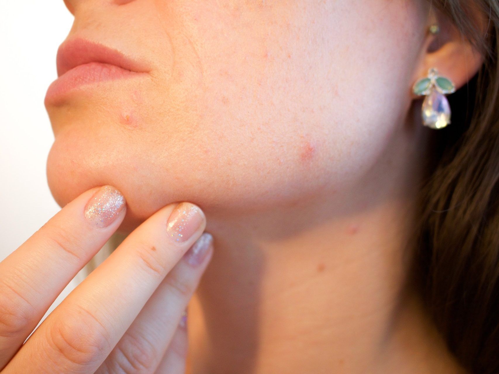 Auch das Leitungswasser kann für unreine Haut verantwortlich sein, warnt ein Dermatologe.