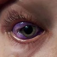 So sieht Catts Auge zur Zeit aus.