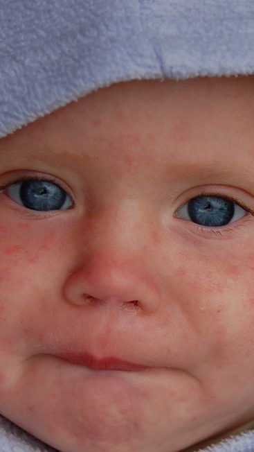 Masern könnte wieder neu aufflammen.