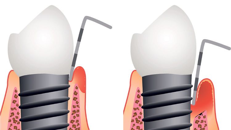 Bei einer Periimplantitis kommt es zu einem zunehmenden Abbau des Knochens um das Implantat. Bei einer Periimplantitis kommt es zu einem zunehmenden Abbau des Knochens um das Implantat.