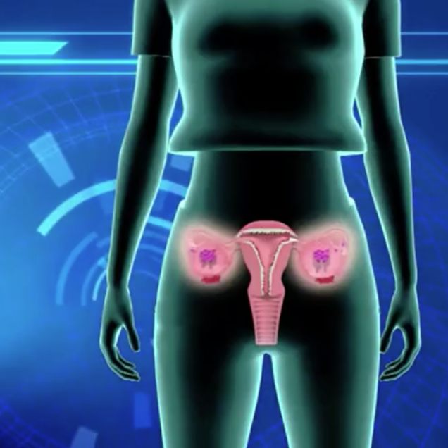 Eierstock-Krebs ist eine tückische Krankheit.