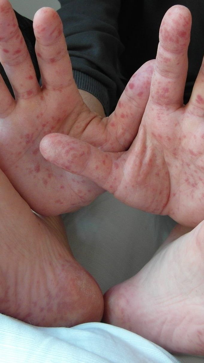 Hand-Fuß-Mund-Krankheit.