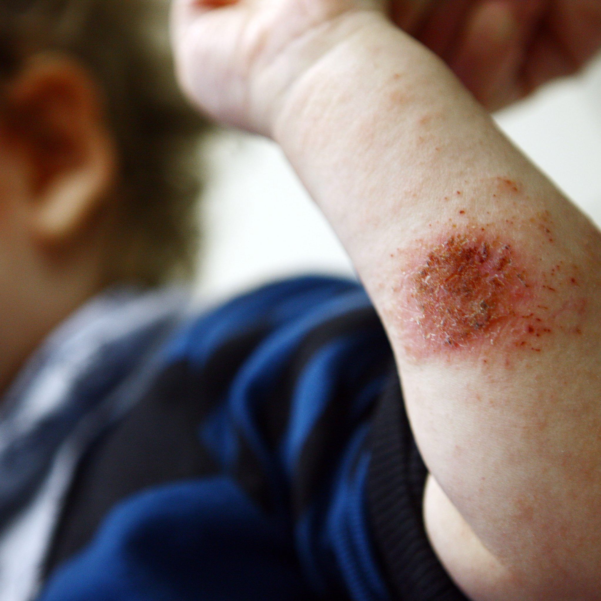 Jedes fünfte Kind leidet an Neurodermitis.