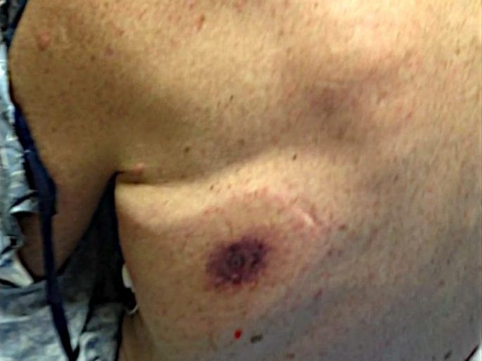 Auf dem Rücken des Mannes tauchten ein schwarzer Fleck und Beulen auf.