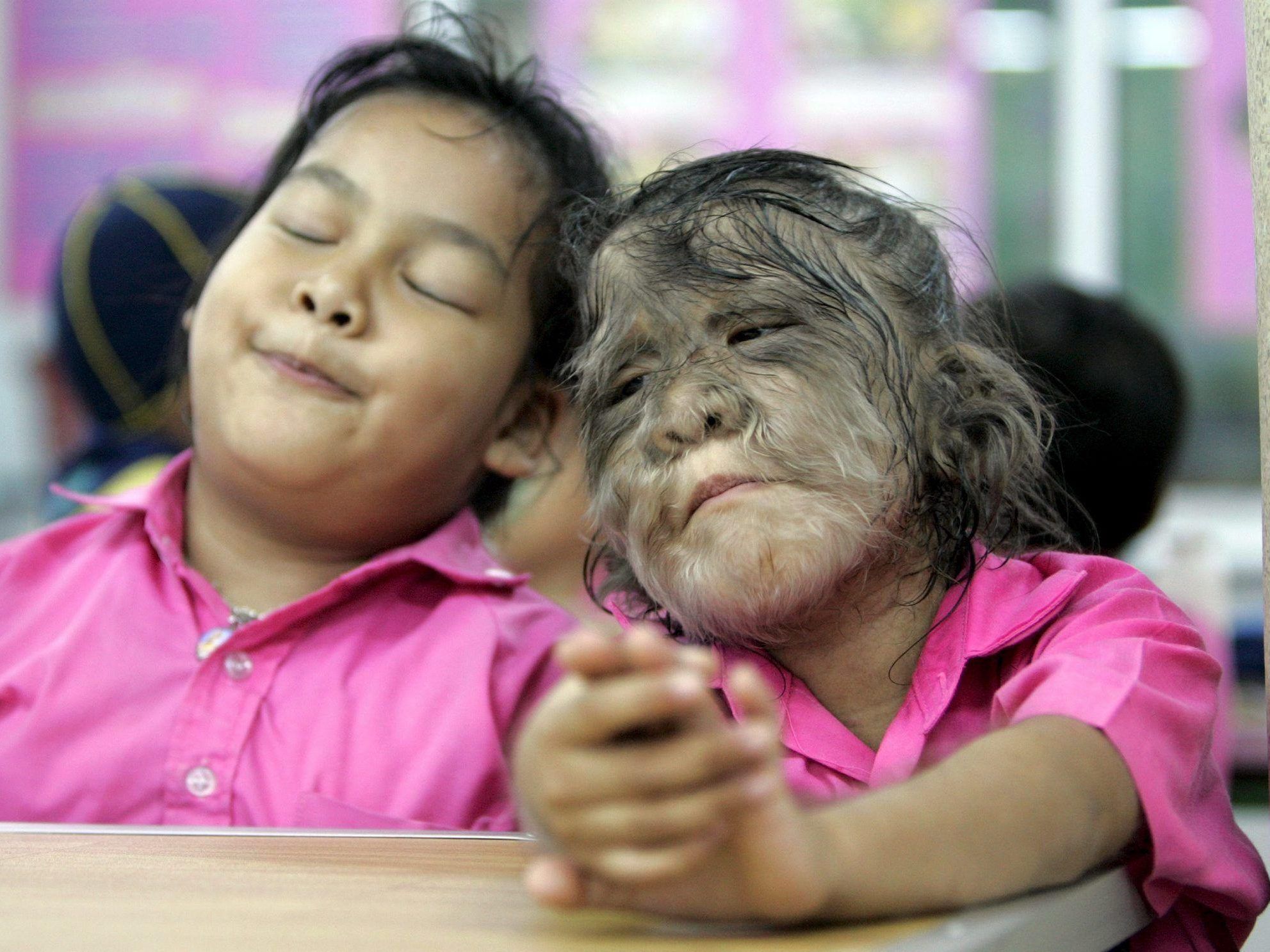 Ein Fall von Hypertochose./Symbolbild