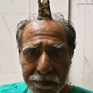Ein Inder lebt fünf Jahre lang mit einem Horn auf dem Kopf.