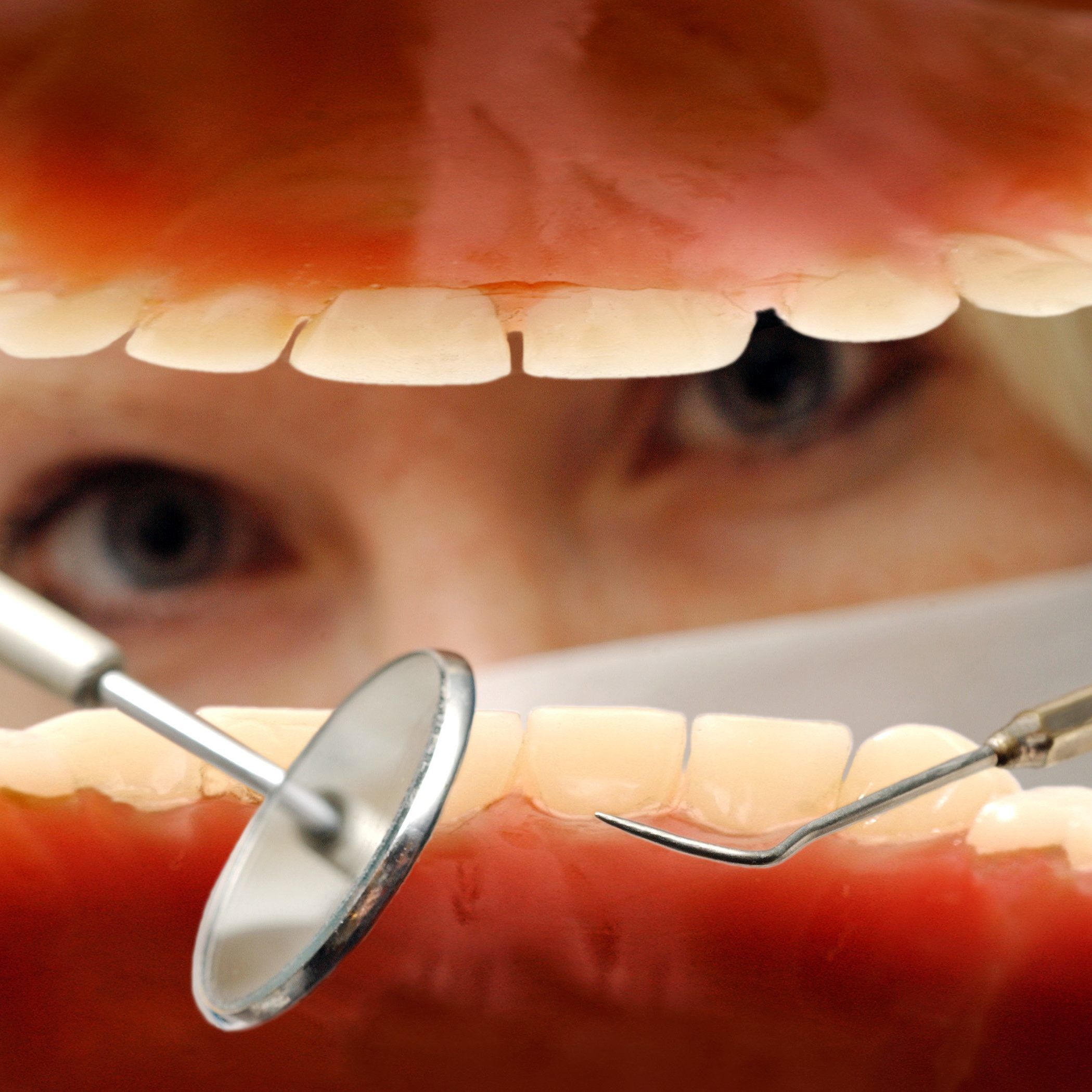 Riesenzahn: Da staunte der Zahnarzt.