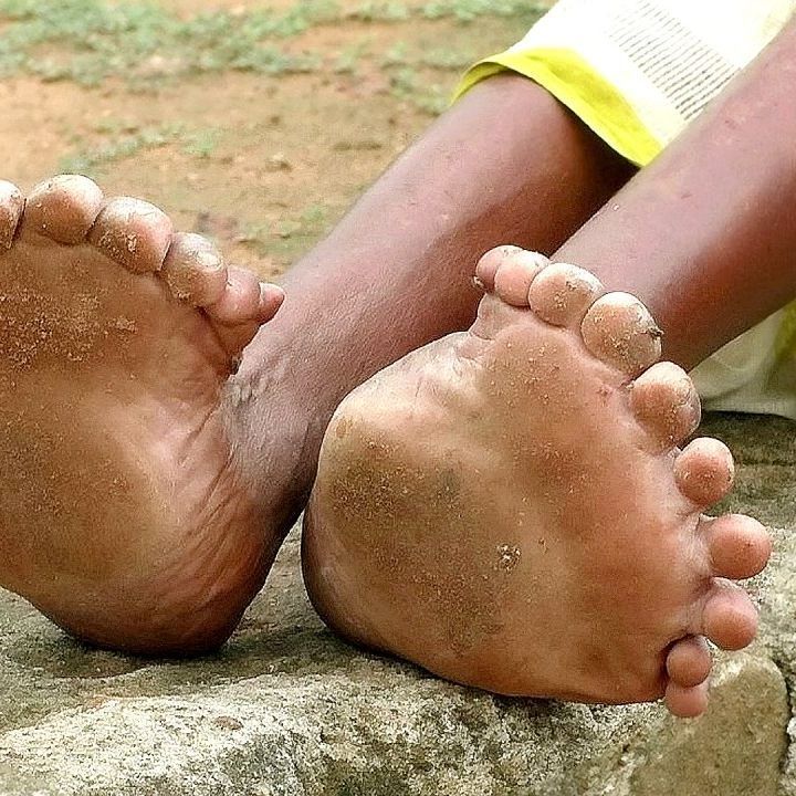 Mit Polydaktylie geboren