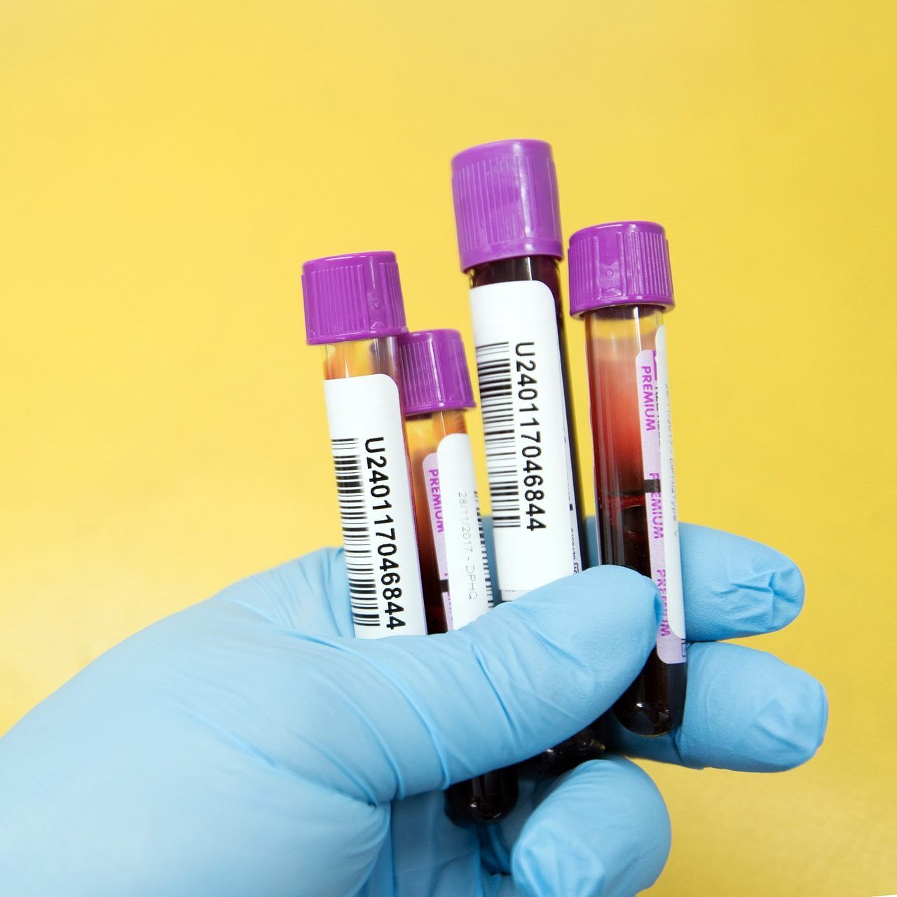 Die Aids Hilfe Wien bietet einen gratis Hepatitis-Test an.