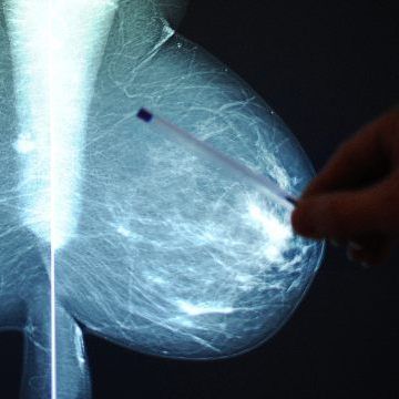 Während des Corona-Lockdowns wurden um 40 Prozent weniger Brustkrebserkrankungen entdeckt.