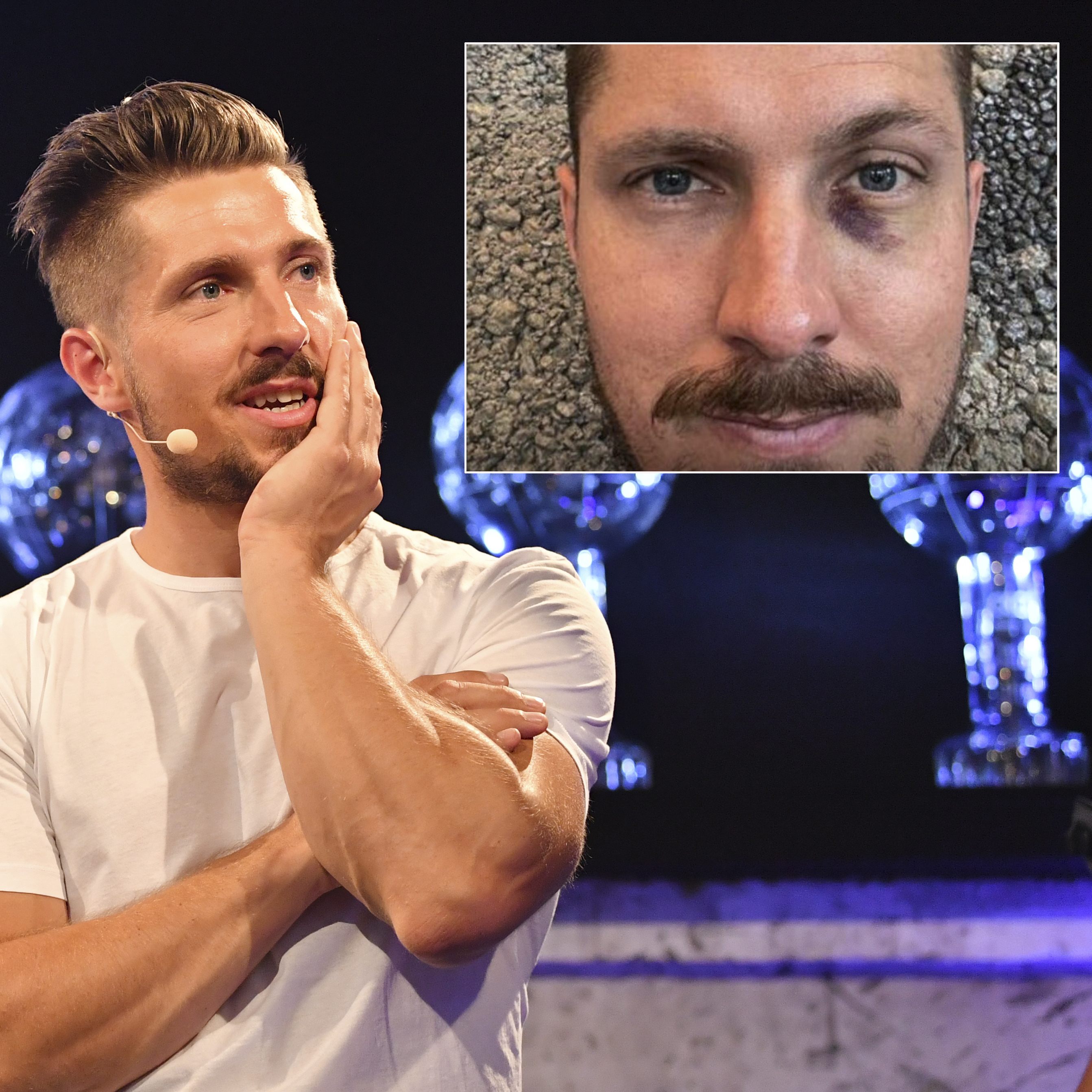 Ex-Skistar Marcel Hirscher hat sich bei einem Sturz ein blaues Auge geholt.