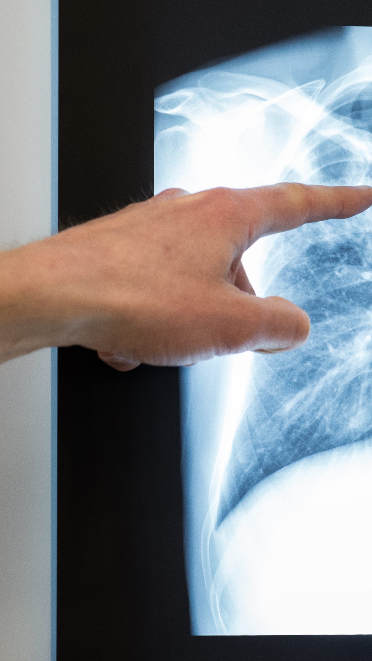 Eine Tuberkulose-Erkrankung manifestiert sich meist in der Lunge.