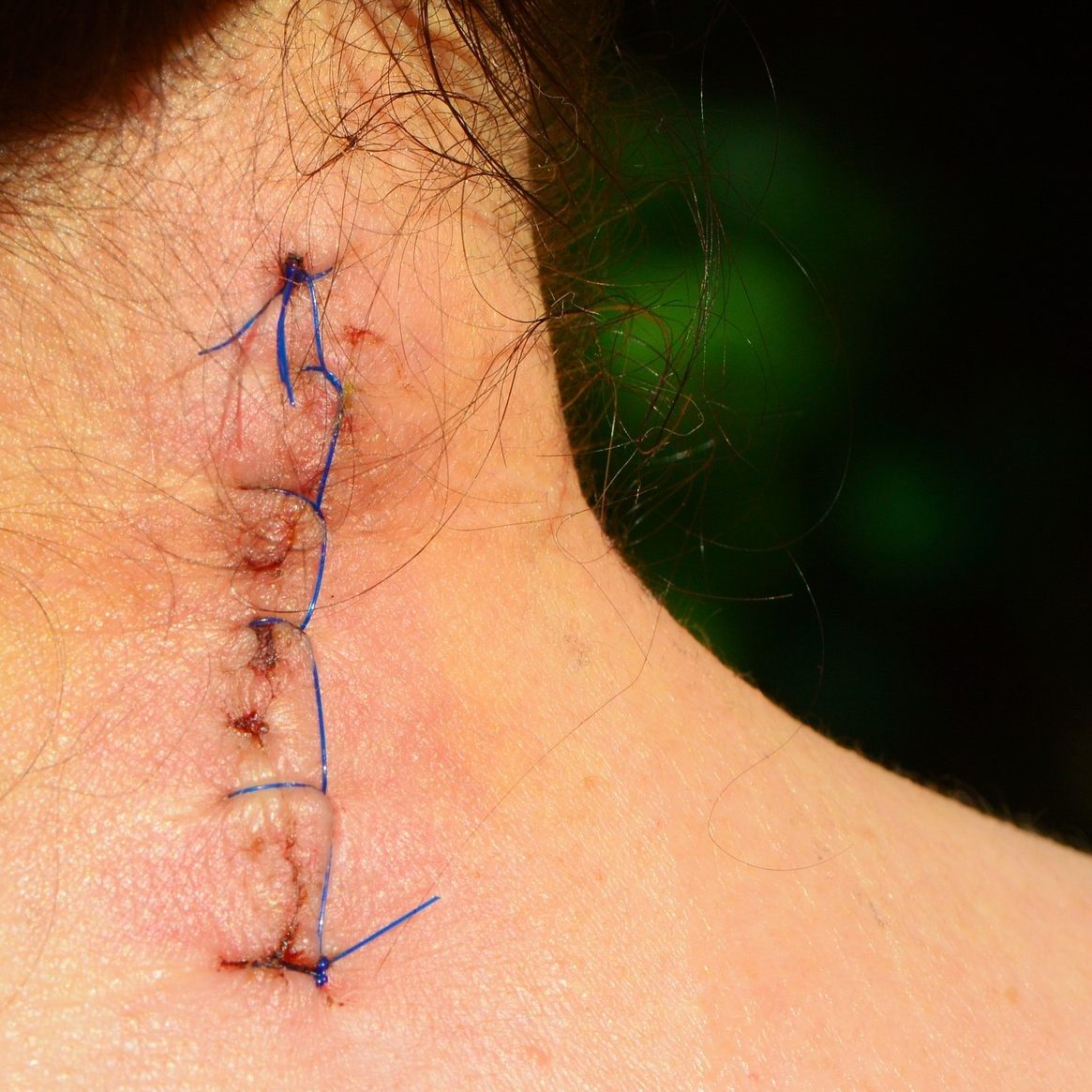 Narben richtig pflegen - Anmeldung zum Webinar.