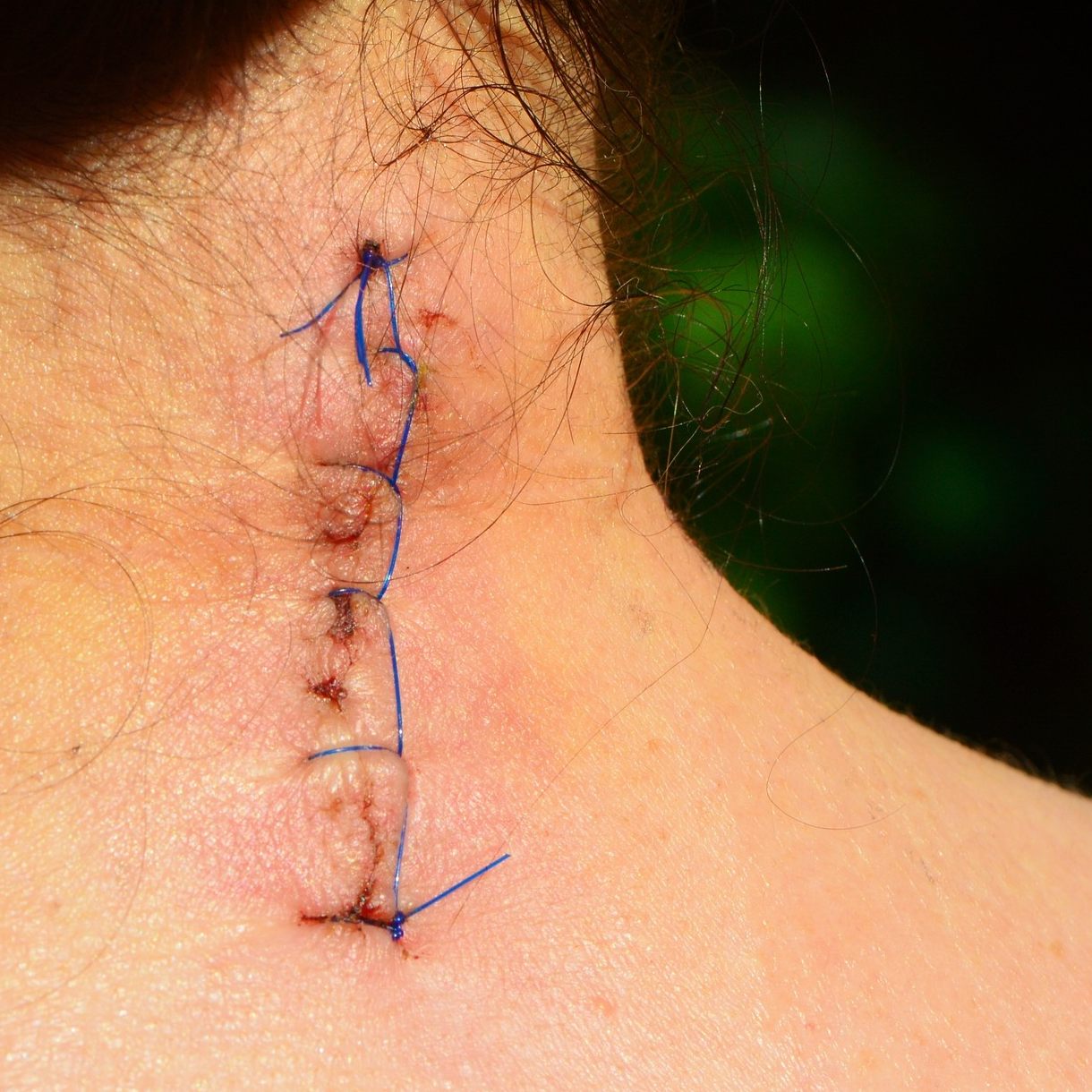 Bei der Narbenreifung können verschiedene Probleme auftreten.