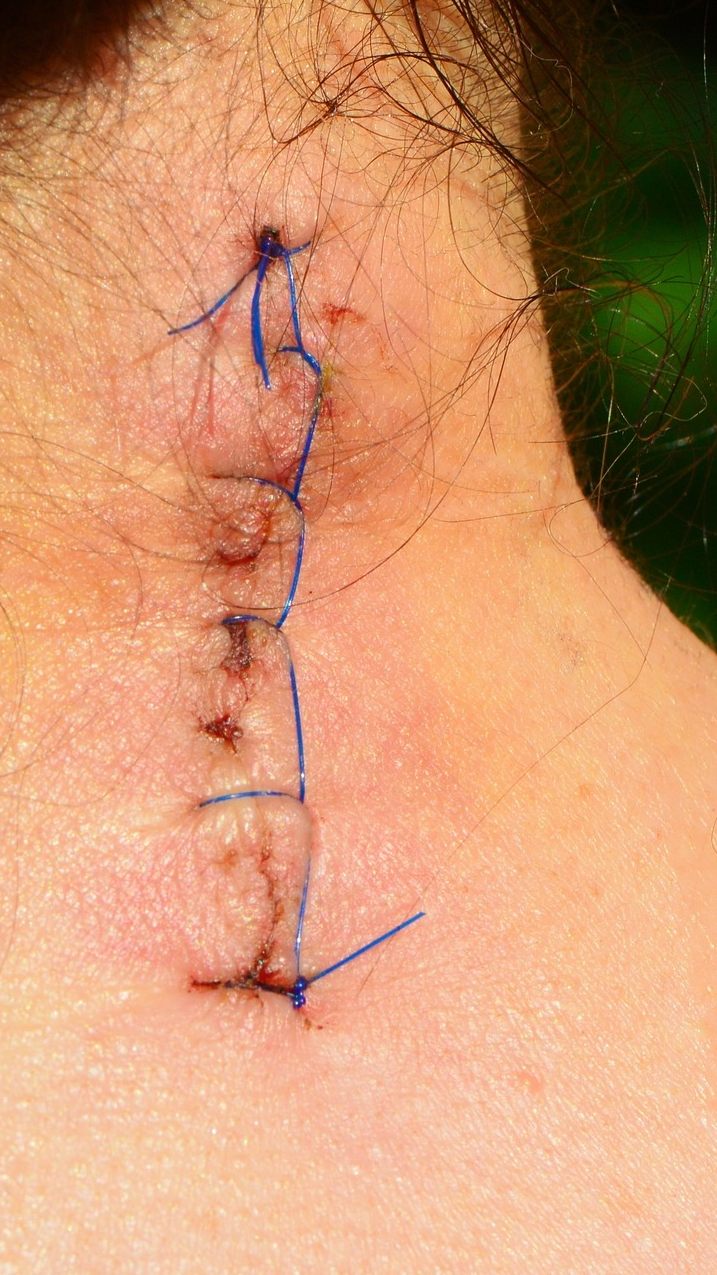 Bei der Narbenreifung können verschiedene Probleme auftreten.