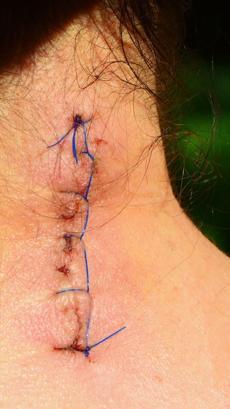 Narben richtig pflegen - Anmeldung zum Webinar.