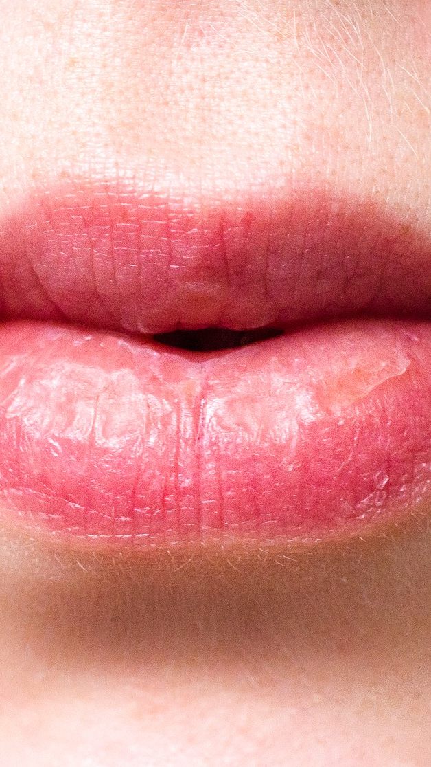 Wenn die Immunkraft sinkt, kommt oft der Lippenherpes.