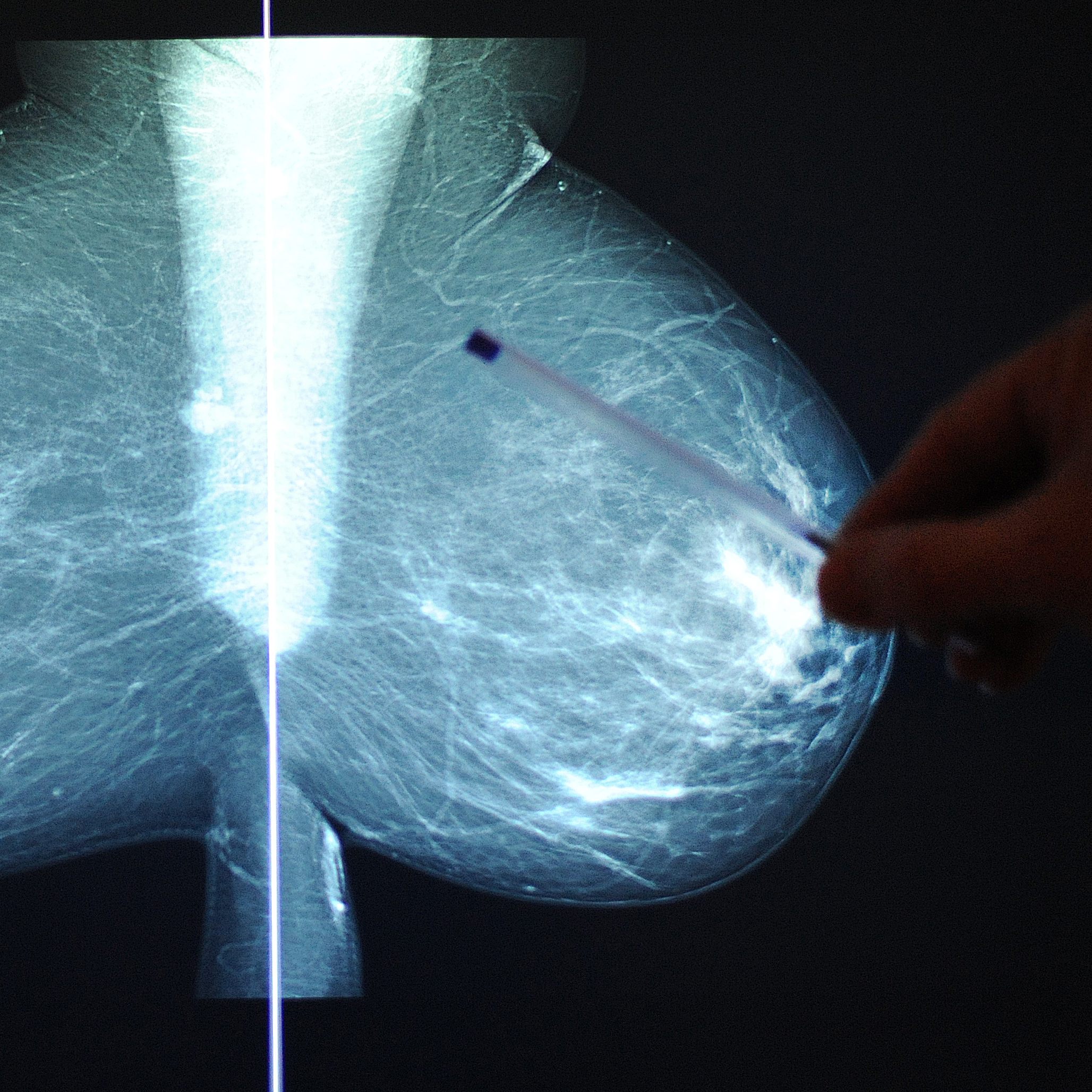 Das Bruströntgenbild einer Patientin im Rahmen einer Vorsorgeuntersuchung zu Brustkrebs.