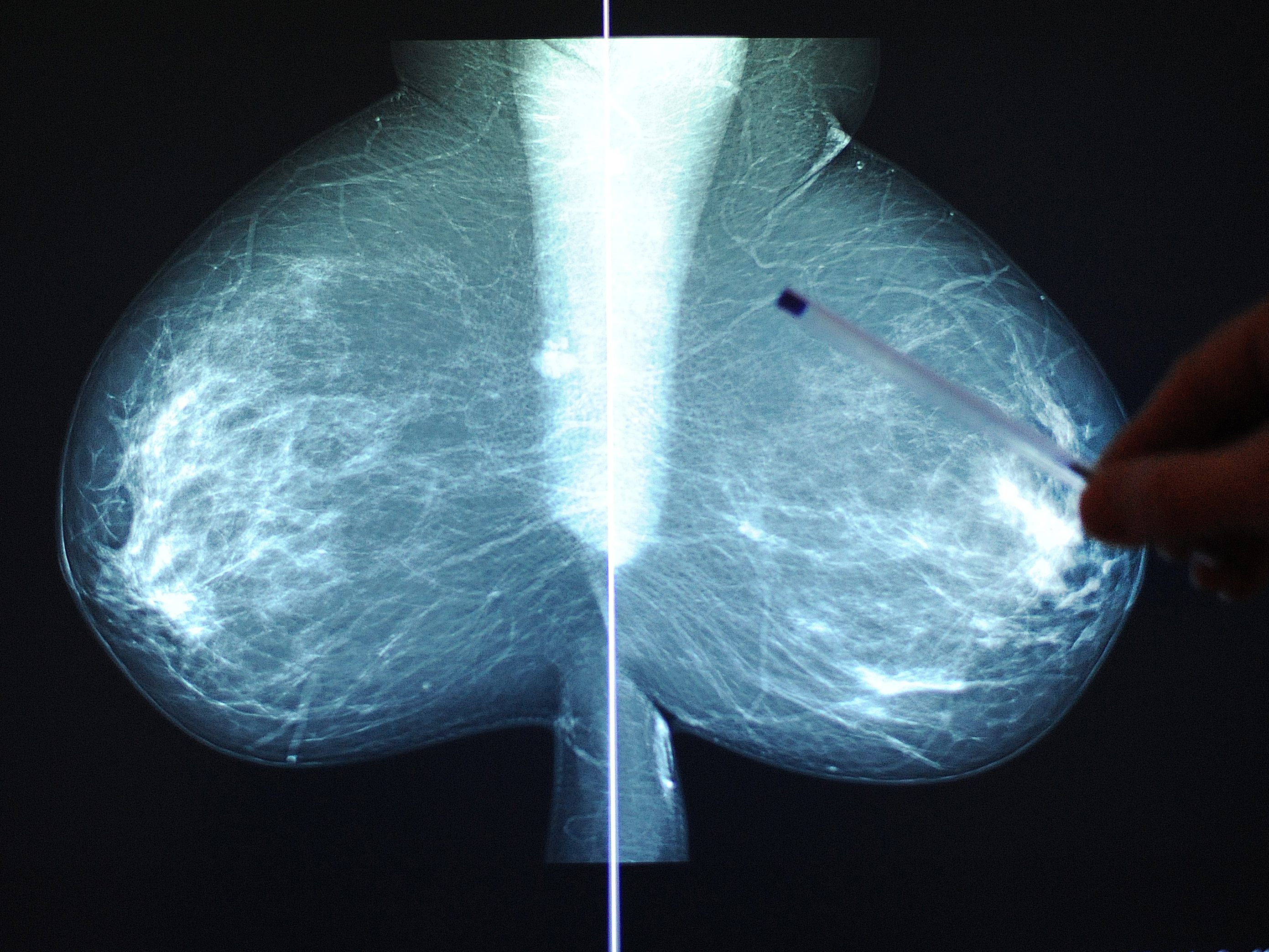 Das Bruströntgenbild einer Patientin im Rahmen einer Vorsorgeuntersuchung zu Brustkrebs.