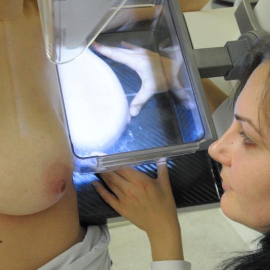 Eine gezielte Strahlentherapie soll die Behandlungsdauer bei Brustkrebs verkürzen.