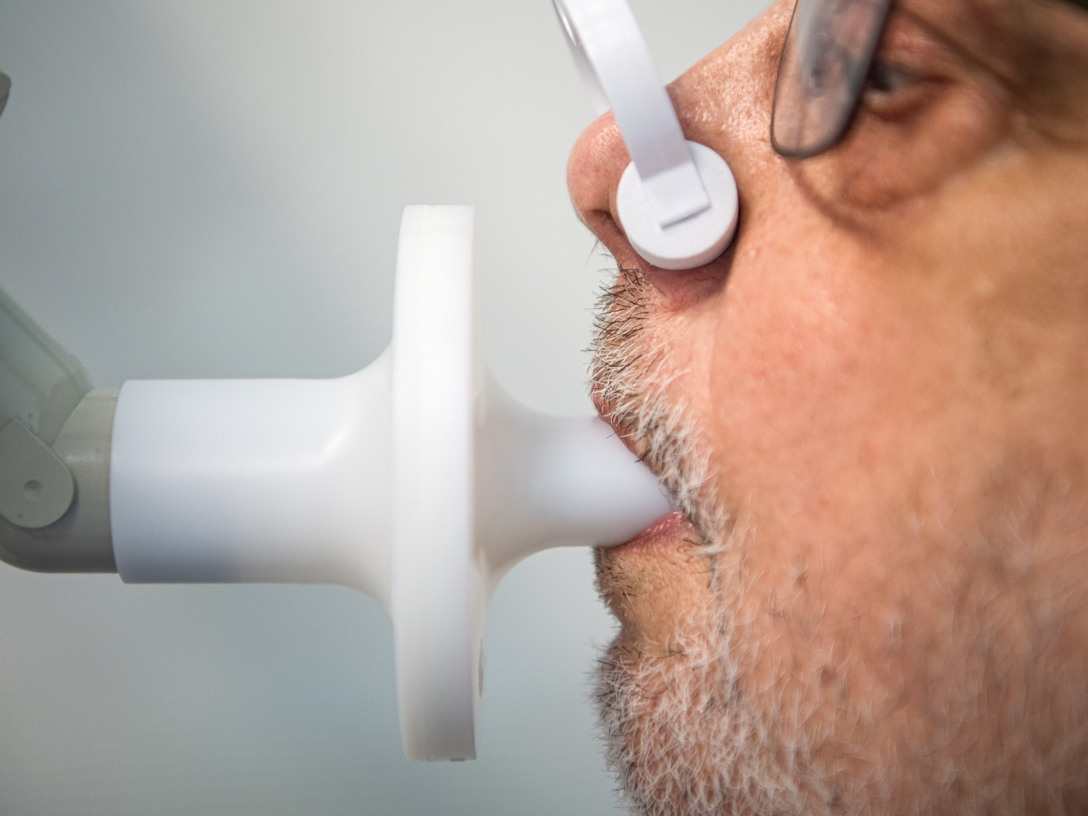 Schweizer Mediziner beobachteten eine neue Form von Lungenfibrose bei hospitalisierten Corona-Patienten. Schweizer Mediziner beobachteten eine neue Form von Lungenfibrose bei hospitalisierten Corona-Patienten.