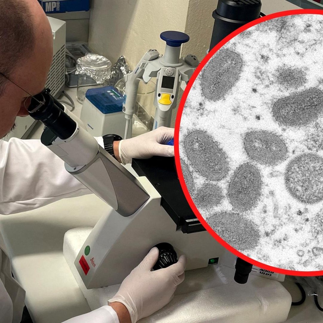 35-Jähriger wies typische Symptome der Affenpocken auf - Genaue Diagnose spätestens Montagfrüh erwartet.