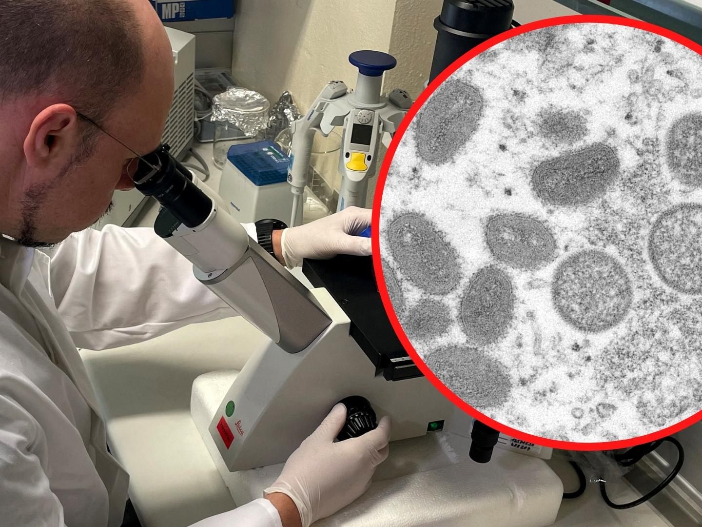 35-Jähriger wies typische Symptome der Affenpocken auf - Genaue Diagnose spätestens Montagfrüh erwartet.