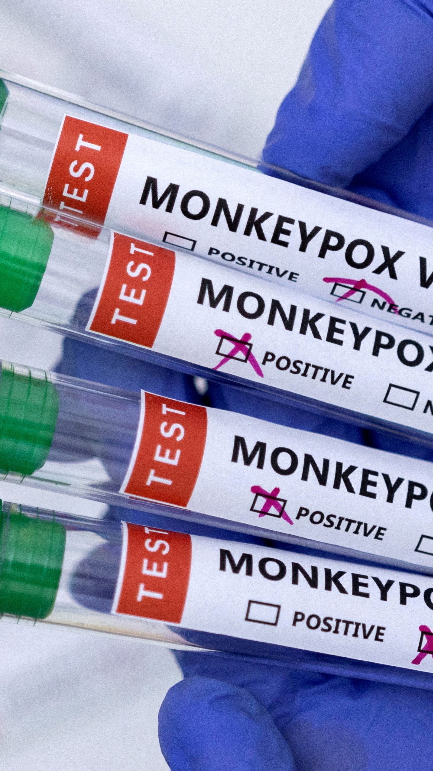 Die Ausbreitung der Affenpocken ist, laut WHO, noch zu stoppen.