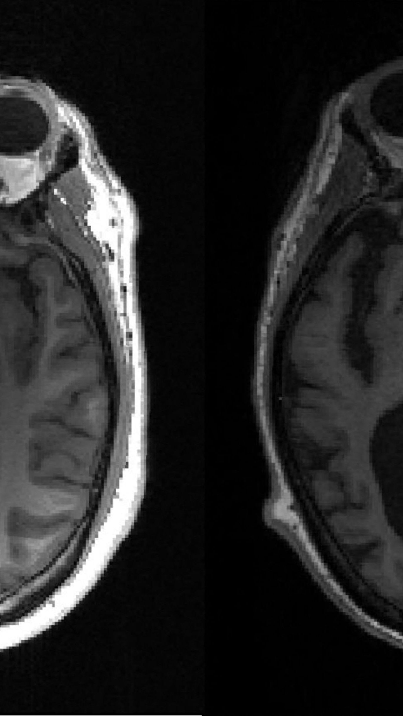 Laut dem Mediziner Peter Dal-Bianco sei Demenz zu 40 Prozent mit einem gesunden Lebensstil vermeidbar.