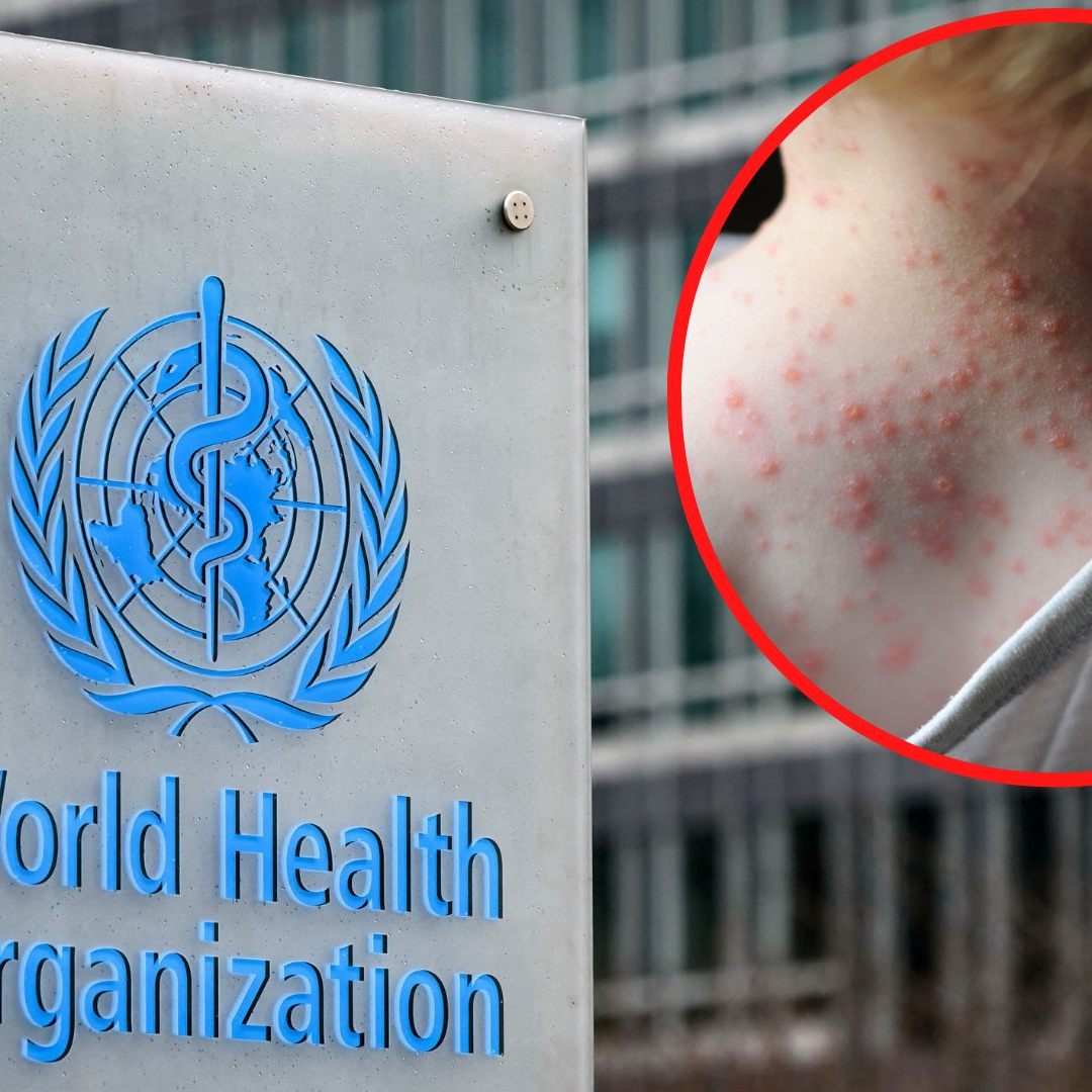 Die WHO entscheidet am Samstag über den Gesundheitsnotstand aufgrund von Affenpocken,