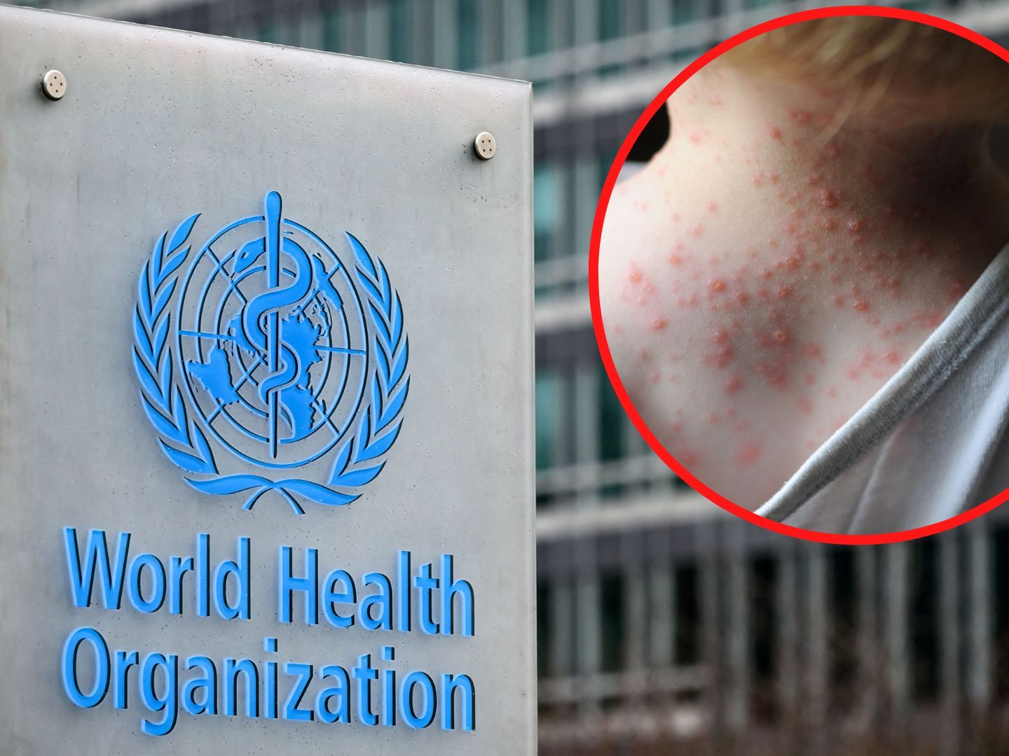 Die WHO entscheidet am Samstag über den Gesundheitsnotstand aufgrund von Affenpocken,
