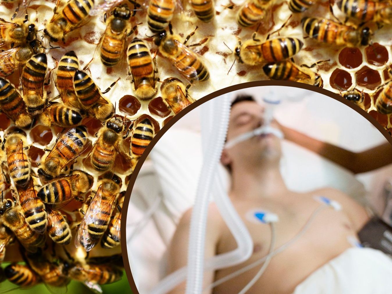 Ein 20-Jähriger musste ins künstliche Koma versetzt werden, nachdem er 20.000 Mal von Killerbienen gestochen worden war. Ein 20-Jähriger musste ins künstliche Koma versetzt werden, nachdem er 20.000 Mal von Killerbienen gestochen worden war.