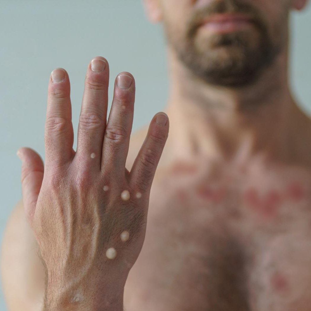 Bei der Variante "Clade I" handelt es sich laut "New Scientist"-Magazin um eine viel aggressivere Mutation.