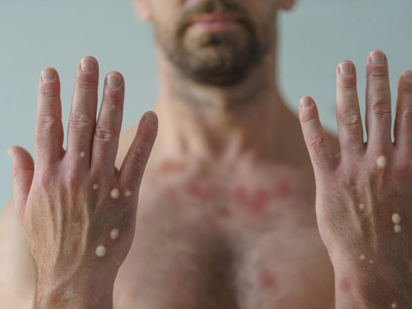 Bei der Variante "Clade I" handelt es sich laut "New Scientist"-Magazin um eine viel aggressivere Mutation.