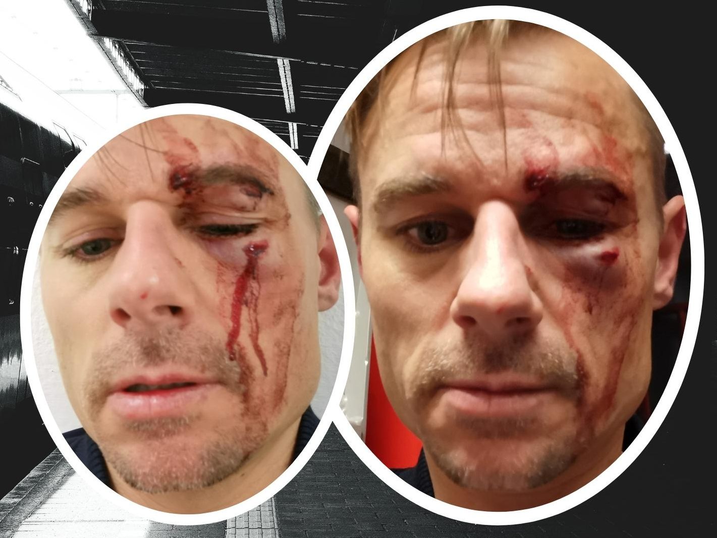 Weil er Zivilcourage zeigte, wurde Nicolas F. aus Feldkirch brutal zusammengeschlagen. Weil er Zivilcourage zeigte, wurde Nicolas F. aus Feldkirch brutal zusammengeschlagen.