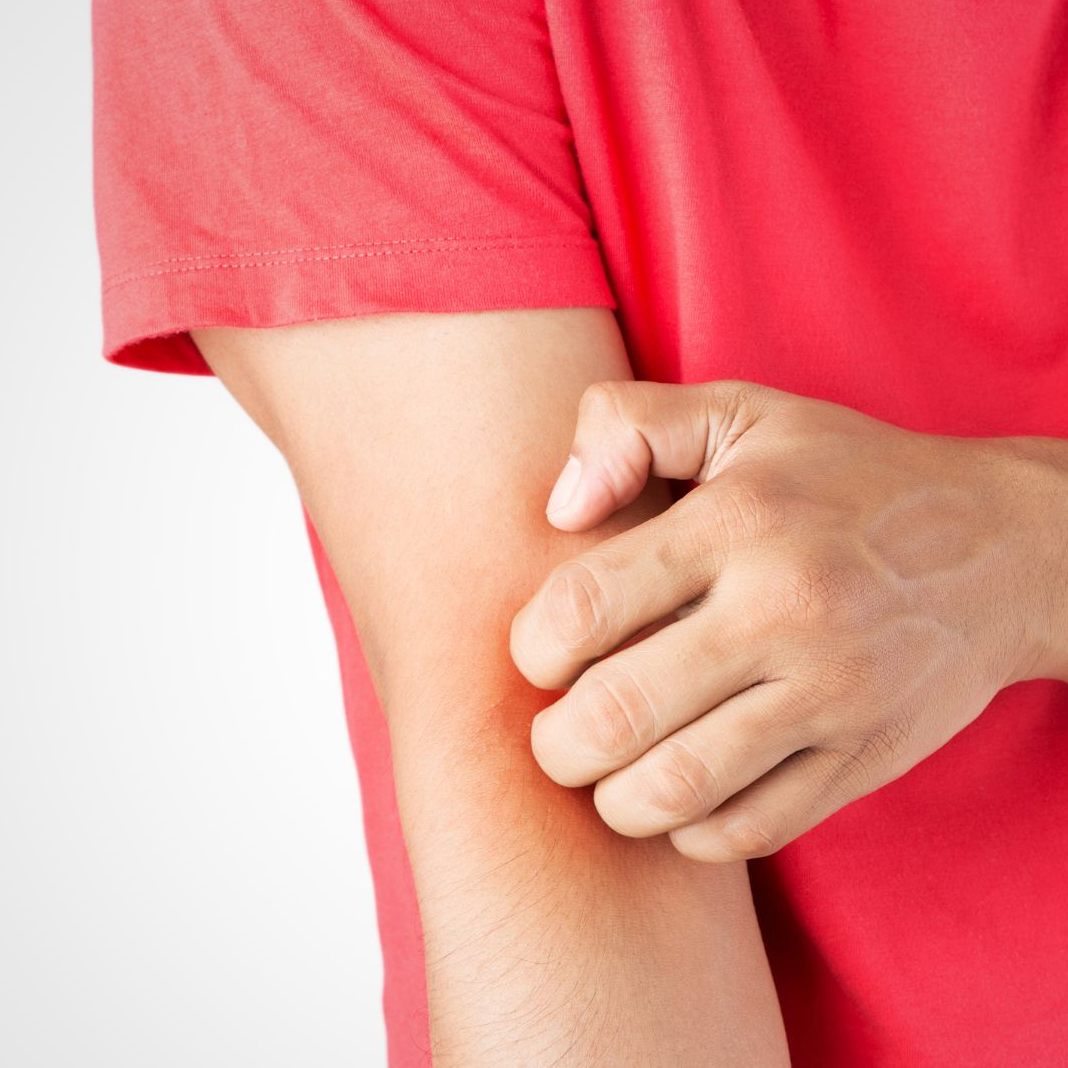 Schwarztee kann die Haut bei Neurodermitis-Schüben beruhigen. (Symbolbild)