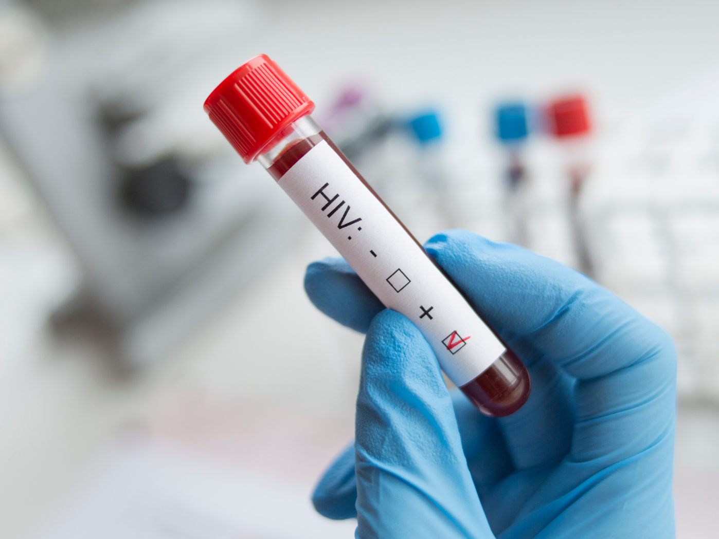 HIV-Infektionen sind in Österreich wieder auf dem Vormarsch.