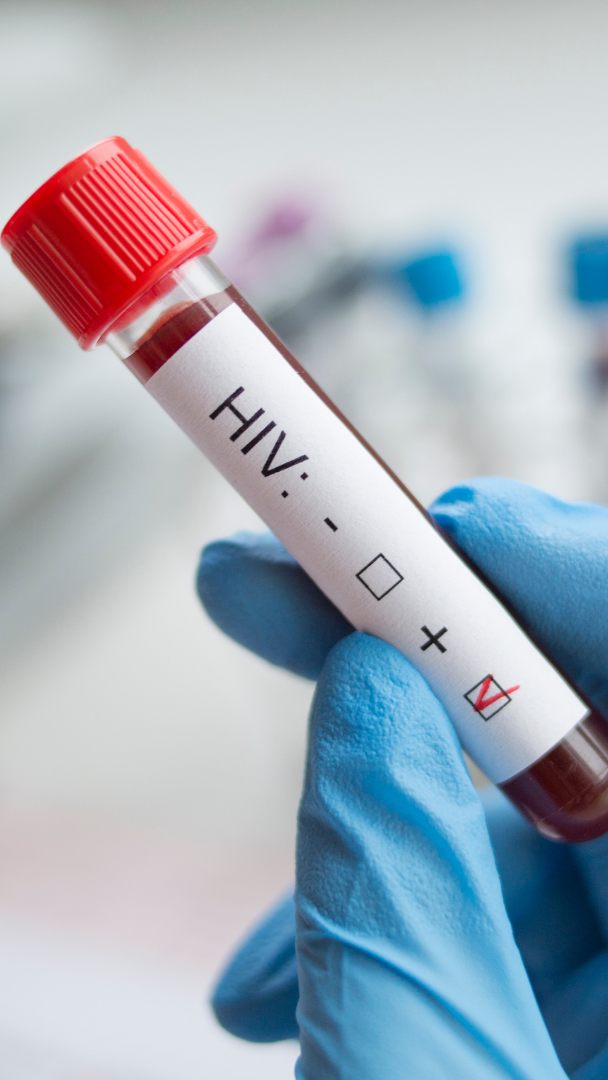 HIV-Infektionen sind in Österreich wieder auf dem Vormarsch.