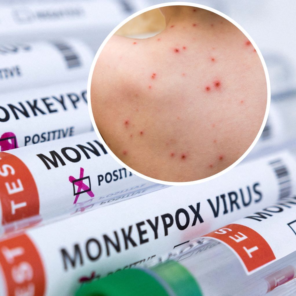 Die WHO sieht großes Gefahrenpotential im Affenpocken-Virus in Europa.