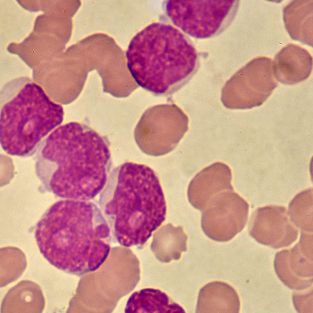 Die neue CLL-Behandlungsmethode funktioniert besser und ist verträglicher.