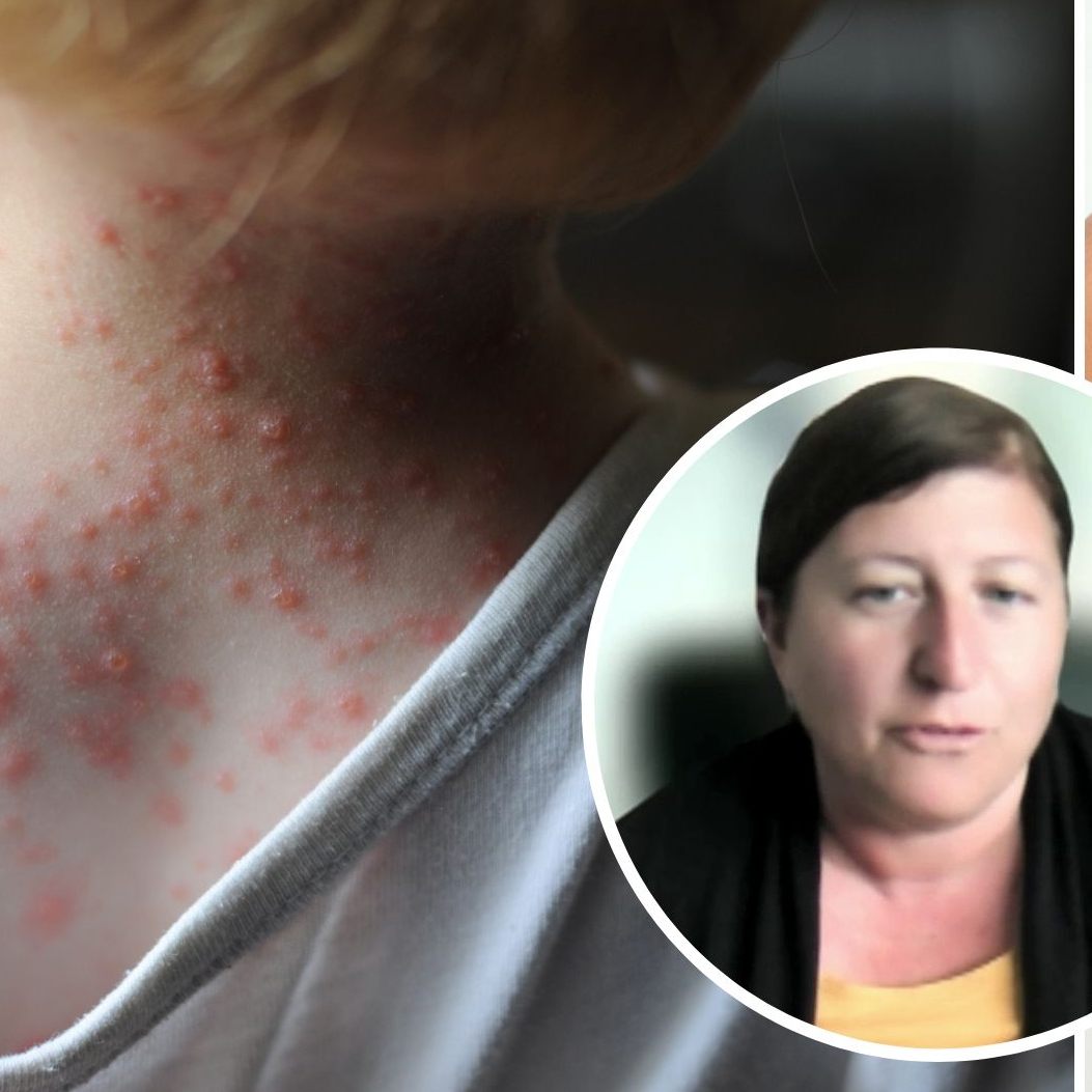 Auch Erwachsene können an Windpocken erkranken, wie Dr. Jonas erklärt.