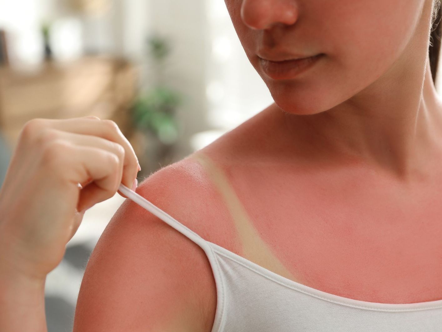 Diese Hausmittel helfen gegen Sonnenbrand. Diese Hausmittel helfen gegen Sonnenbrand.