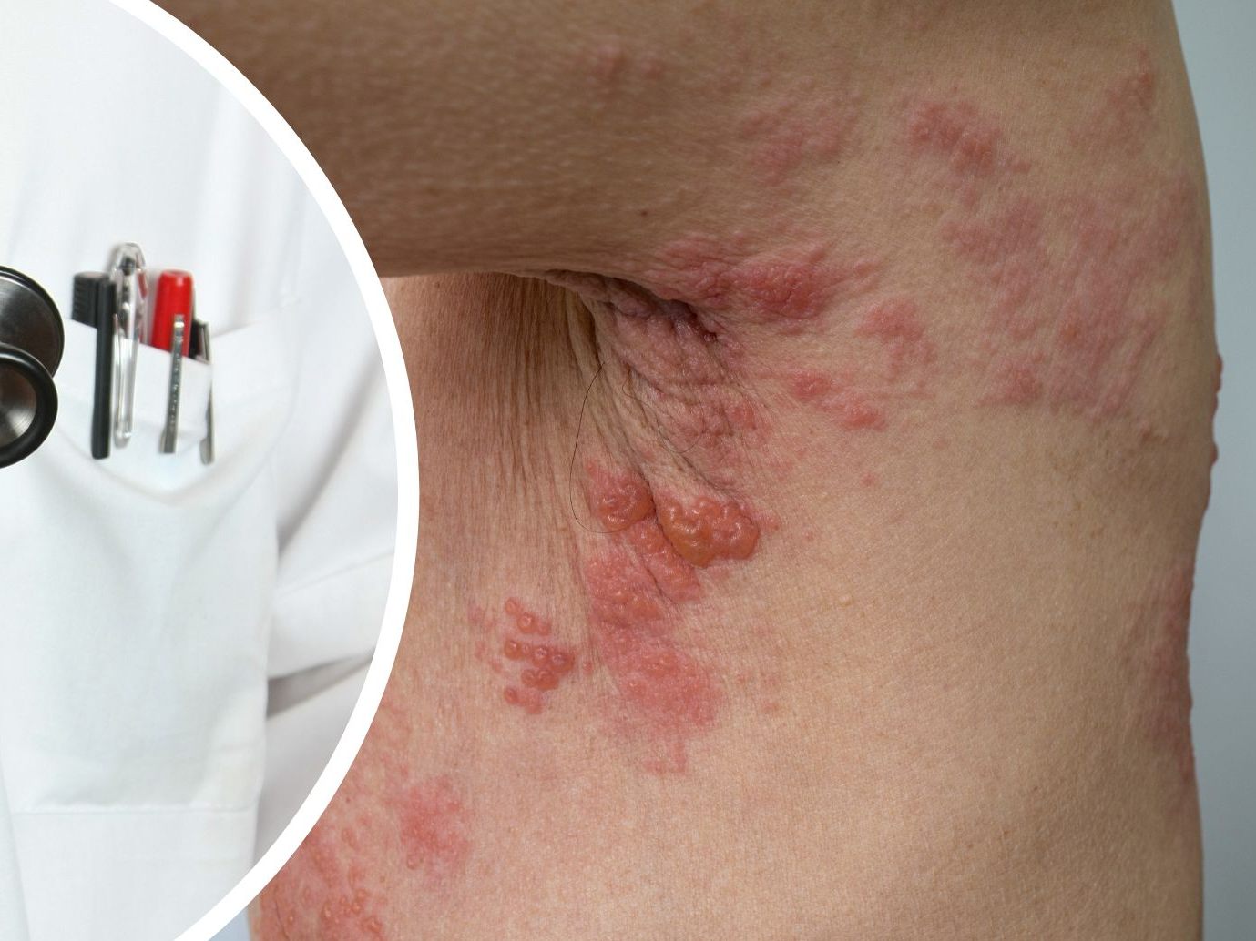 Gegen Herpes-Zoster gibt es eine Impfung.