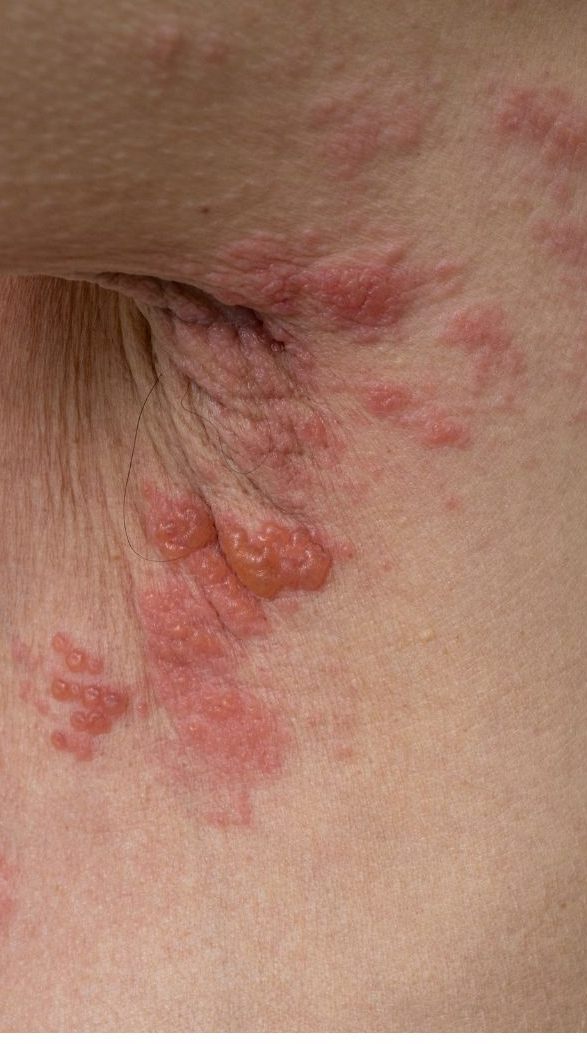 Gegen Herpes-Zoster gibt es eine Impfung.