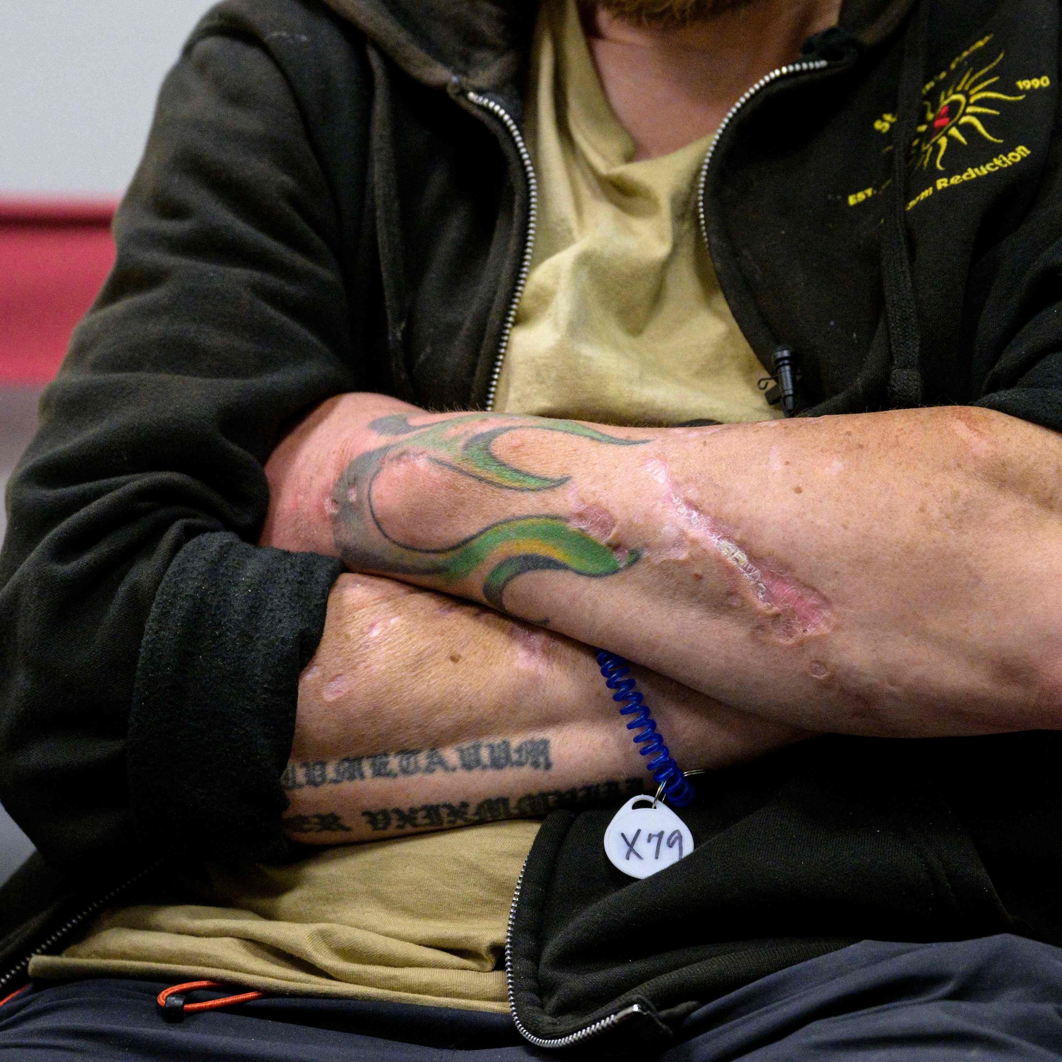 Die "Zombie-Droge" Trunq "frisst" sich durch die Haut.