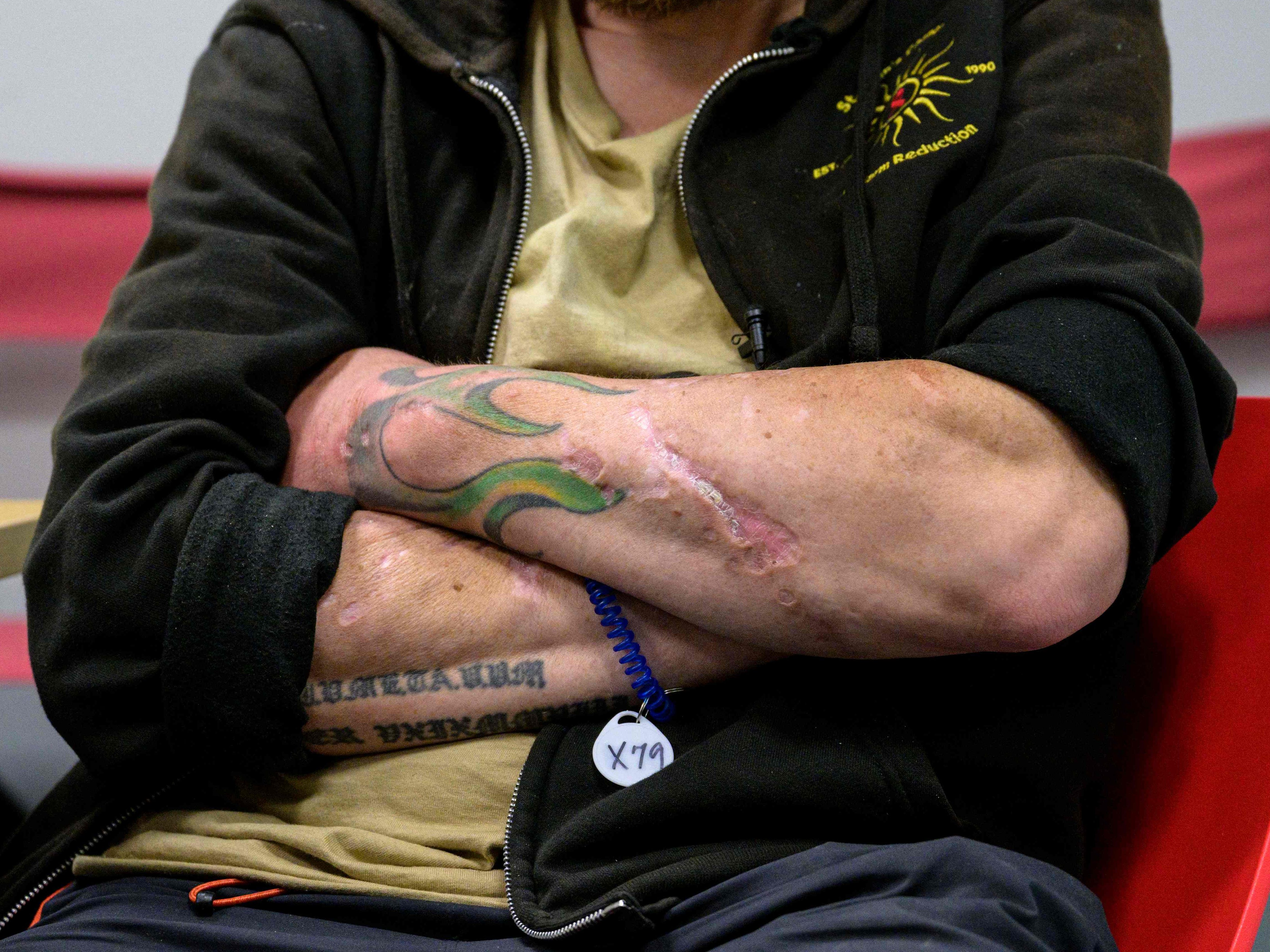 Die "Zombie-Droge" Trunq "frisst" sich durch die Haut.