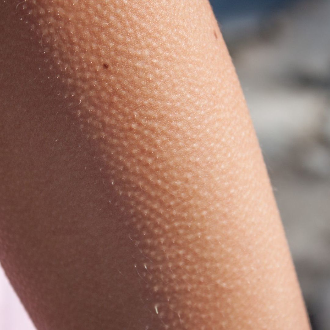 Das steckt hinter Gänsehaut.