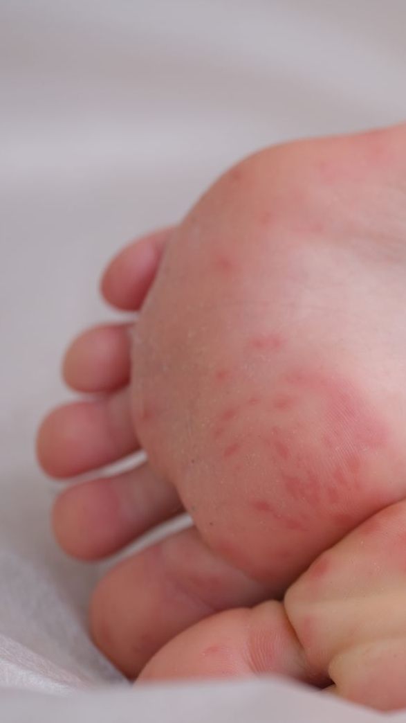 Stecknadelgroße rote Punkte auf der Haut können bei Kindern auf eine Blutvergiftung oder Hirnhautentzündung hinweisen.