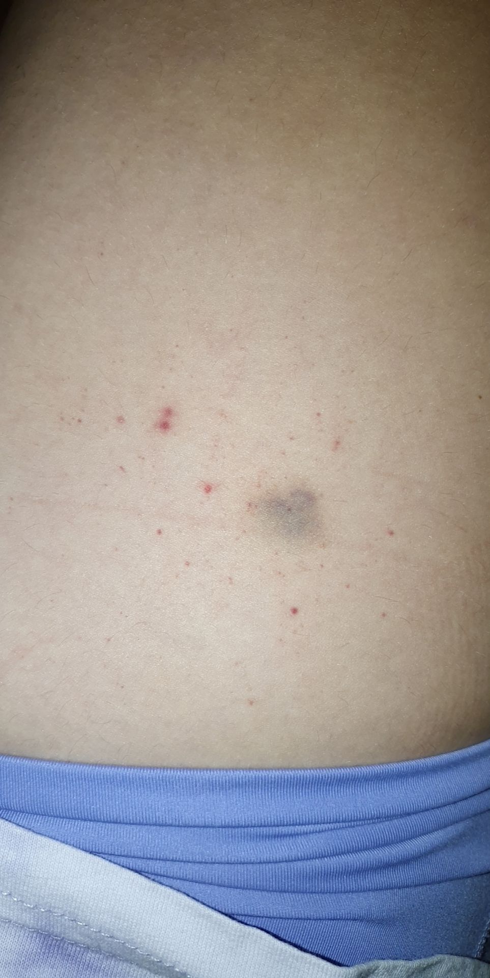 Kleine Punkte auf ihrer Haut, die an kleine Blutergüsse erinnerten. Kleine Punkte auf ihrer Haut, die an kleine Blutergüsse erinnerten.