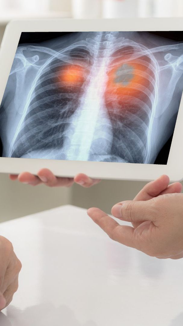 Pro Jahr sterben 4.000 Menschen in Österreich an Lungenkrebs.
